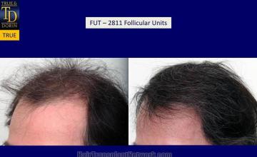 Hair transplantation surgery before and after images