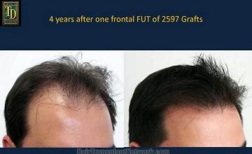 Hair restoration photos - Showing right side before and after