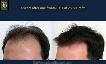 Left side views of before and after hair restoration procedure