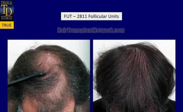 Hair transplantation surgery before and after photos