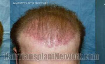 Tilt down view before and after hair transplant results