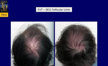 Hair transplantation surgery before and after pictures