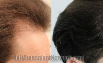 Hair transplantation surgery before and after images