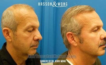 Hair transplantation surgery before and after images