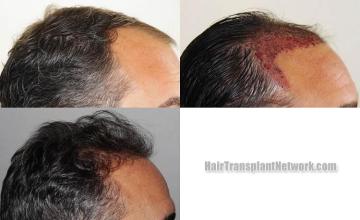 Hair transplantation surgery before and after images