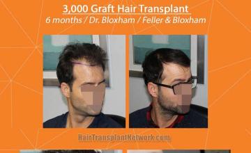 Hair restoration procedure before and after result images