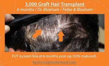 Hair replacement surgery before and after images