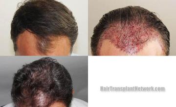 Hair restoration procedure before and after results