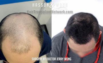 Top view - Before and after hair restoration procedure