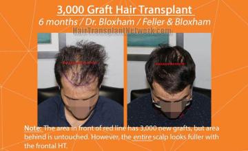 Before and after hair restoration procedure images