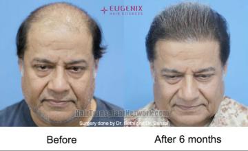 Hair transplantation surgery before and after images