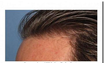 Hair restoration procedure results