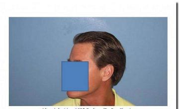 Hair restoration procedure results