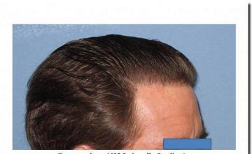 Hair restoration procedure results