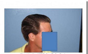 Hair restoration procedure results