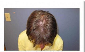 Hair restoration procedure results