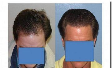 Hair restoration procedure results