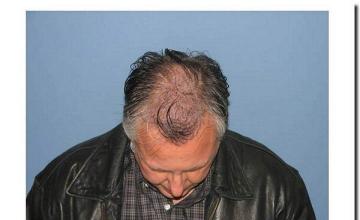 Hair restoration procedure results