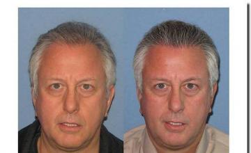 Hair restoration procedure results