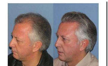 Hair restoration procedure results