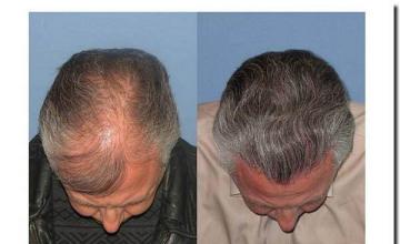 Hair restoration procedure results