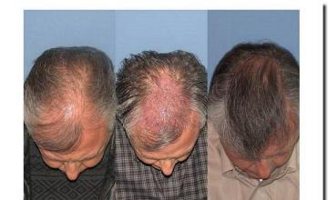 Hair restoration procedure results