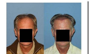 Hair restoration procedure results