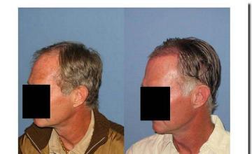 Hair restoration procedure results