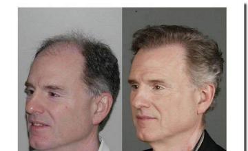 Hair restoration procedure results