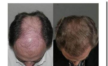 Hair restoration procedure results