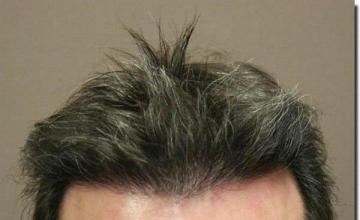 Hair restoration procedure results