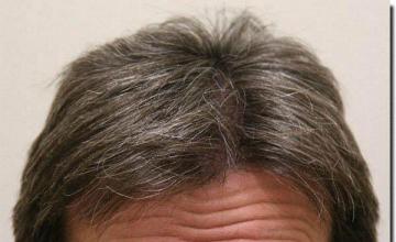 Hair restoration procedure results