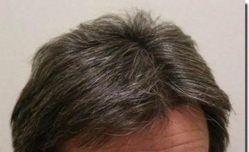 Hair restoration procedure results