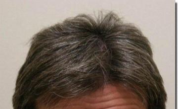 Hair restoration procedure results