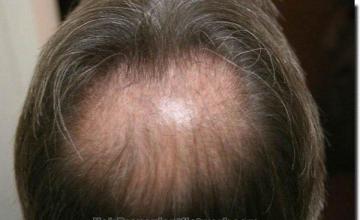 Hair restoration procedure results