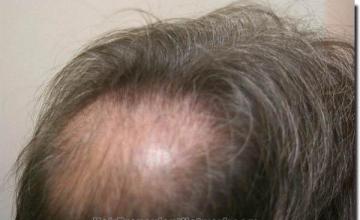 Hair restoration procedure results