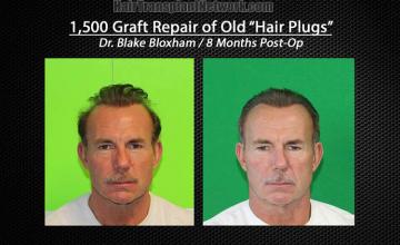 Hair restoration repair procedure before and after pictures