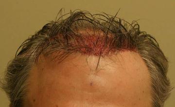 Hair transplantation surgery immediate postoperative