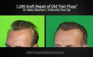 Hair transplantation repair surgery before and after photos