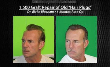 Hair restoration surgery before and after images