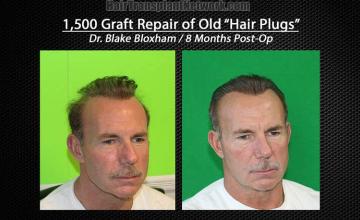 Hair restoration repair procedure before and after results