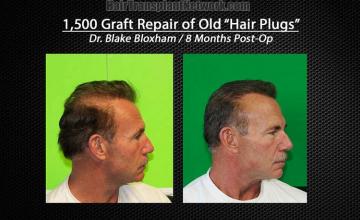 Hair restoration repair surgery before and after photos