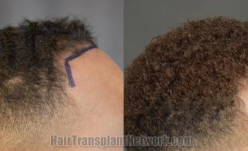 Hair transplantation surgery before and after images