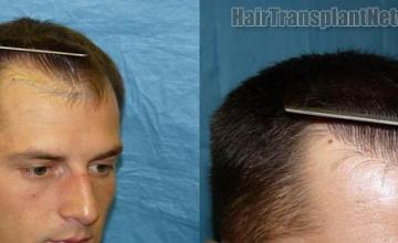 Right view before and after hair transplantation