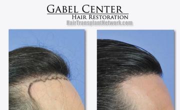 Hair restoration procedure before and after results