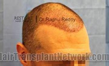 Hair transplantation surgery before and after photos