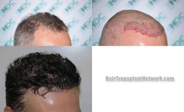 Hair transplantation surgery before and after photos