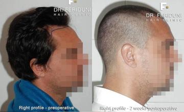 Hair transplantation surgery before and after photos