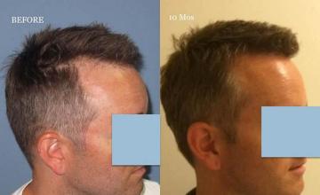 Hair transplantation surgery before and after images