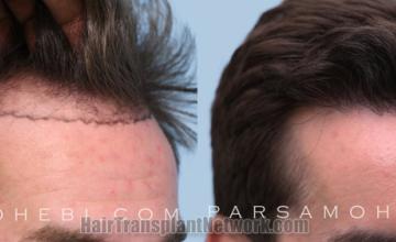 Hair transplantation surgery before and after images